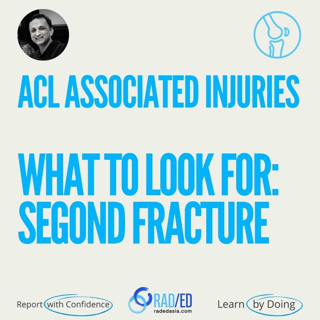 MRI evaluation of ACL-associated second fractures, highlighting key secondary osseous injuries associated with anterior cruciate ligament tears.
