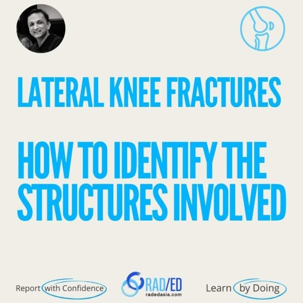 Lateral knee fractures and the ligamentous and tendinous structures involved on knee MRI.