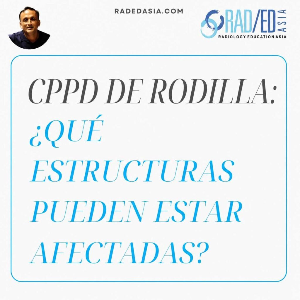 Estructuras de la rodilla afectadas por la CPPD de la rodilla, incluyendo fibrocartílago, cartílago, tendones y ligamentos.