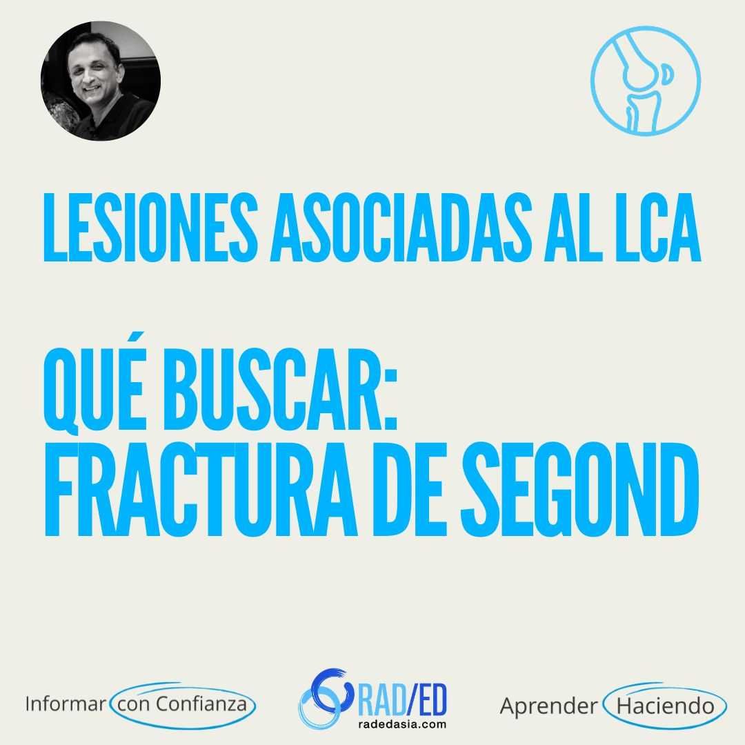 Fracturas laterales de la rodilla y las estructuras ligamentarias y tendinosas involucradas en la RM de rodilla.