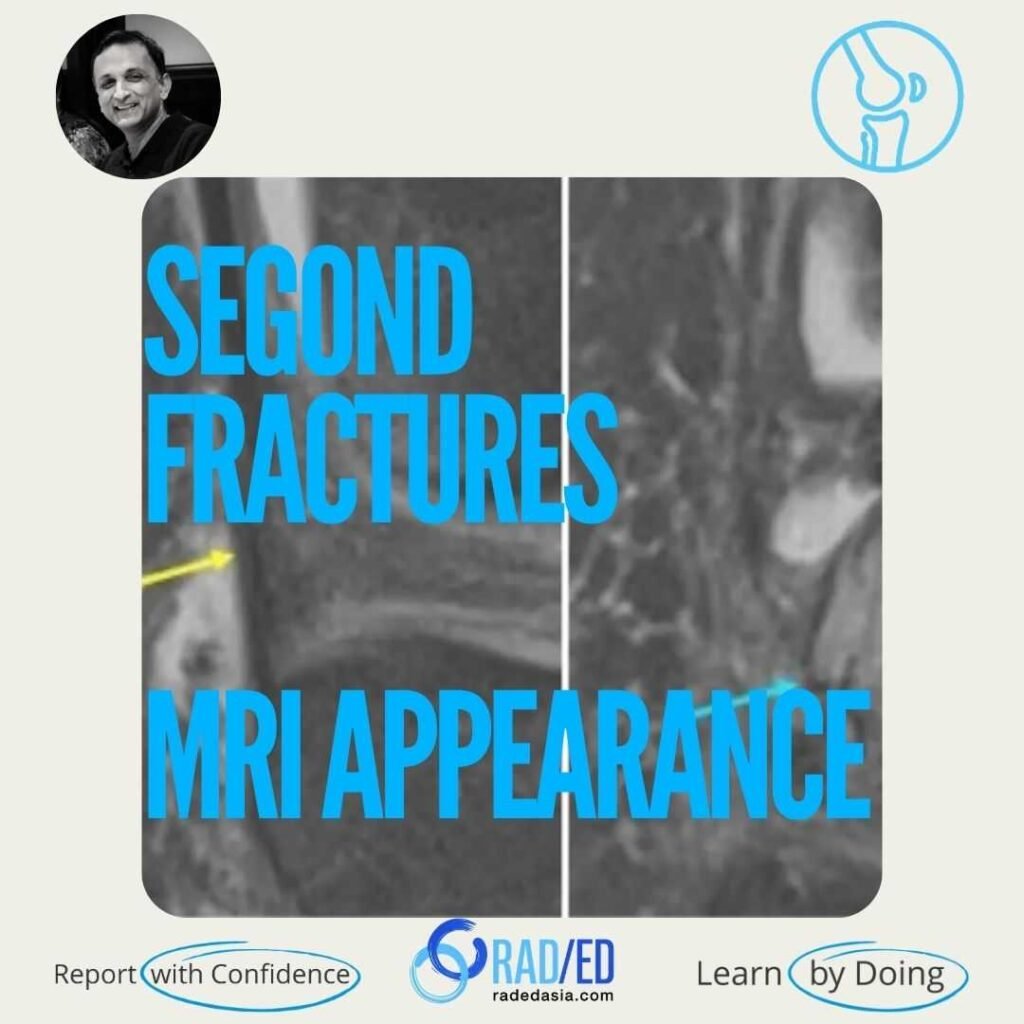 Knee MRI demonstrating the MRI appearance of a Segond fracture, a classic avulsion injury associated with anterior cruciate ligament tears.