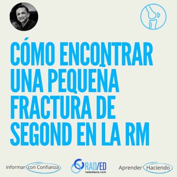 Encontrar una pequeña fractura por avulsión de Segond en la RM.