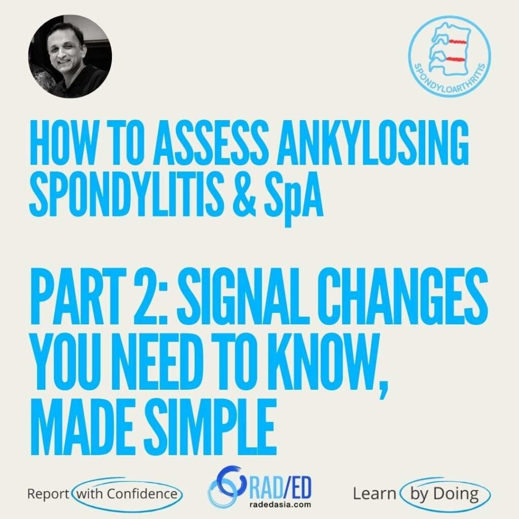 MRI signal changes in ankylosing spondylitis and axial spondyloarthritis, highlighting key inflammatory and structural findings.
