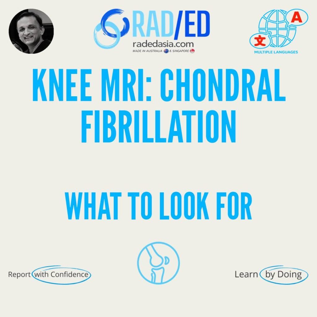 Sagittal PD MRI of the knee showing toothbrush-like irregularity of the cartilage surface consistent with chondral fibrillation