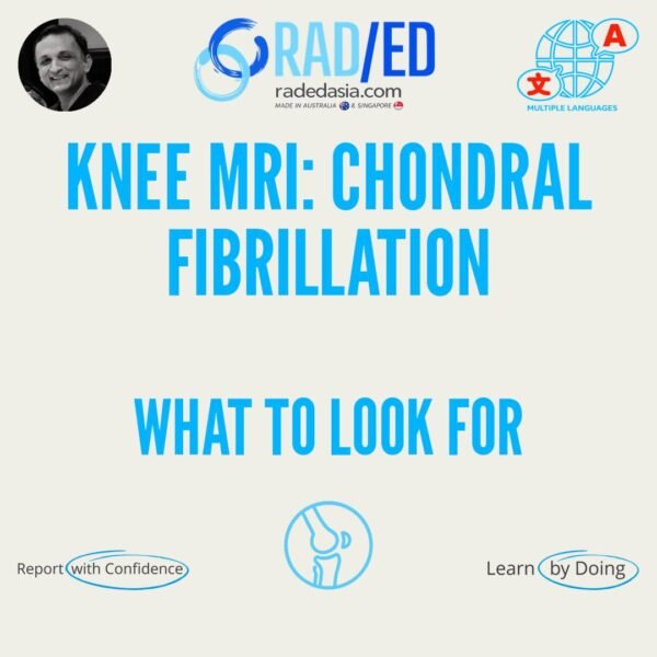 Sagittal PD MRI of the knee showing toothbrush-like irregularity of the cartilage surface consistent with chondral fibrillation
