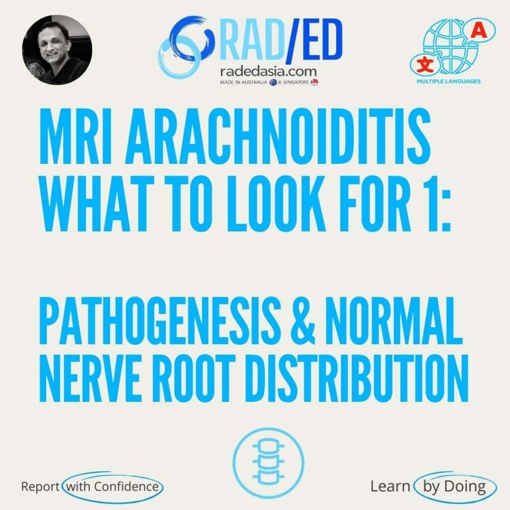 MRI arachnoiditis illustrating pathogenesis and normal cauda equina nerve root distribution.