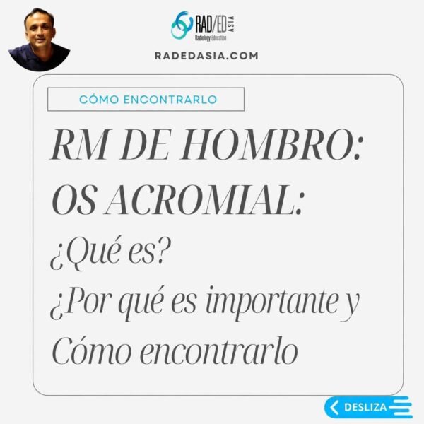 Os acromiale, su importancia clínica y cómo identificar este centro de osificación acromial no fusionado.