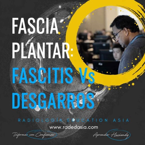 RM de la fascia plantar que demuestra las características de imagen que diferencian la fascitis plantar de los desgarros de la fascia plantar en la evaluación del dolor de talón.
