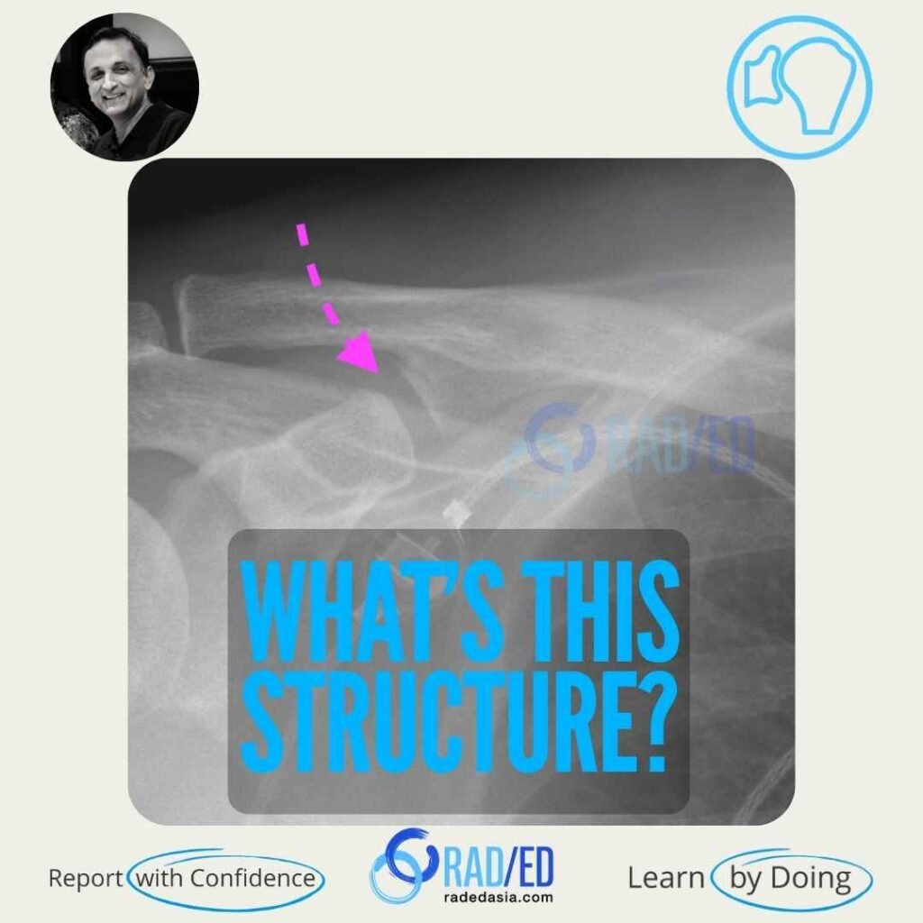 Shoulder X-ray showing a coracoclavicular joint, an anatomical variant between the coracoid process and clavicle.