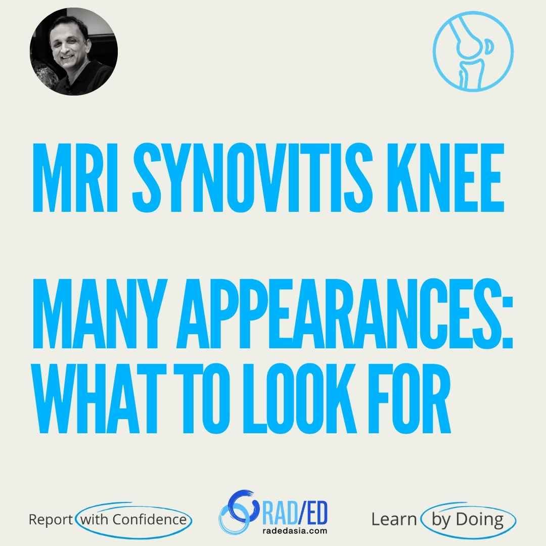 MRI synovitis of the knee showing varied appearances and key imaging findings for radiologists.