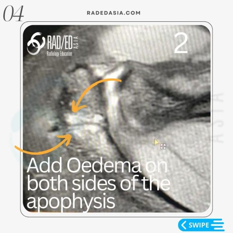 acromial-apophysiolysis-apophysitis-os-acromiale-mri-shoulder-radiology.jpg