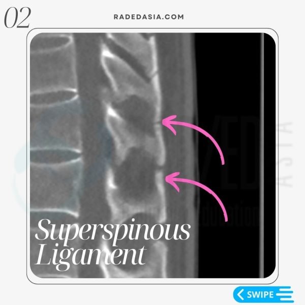 ankylosing spondylitis spine fusion superspinous ligament radiology mri ct images radedasia