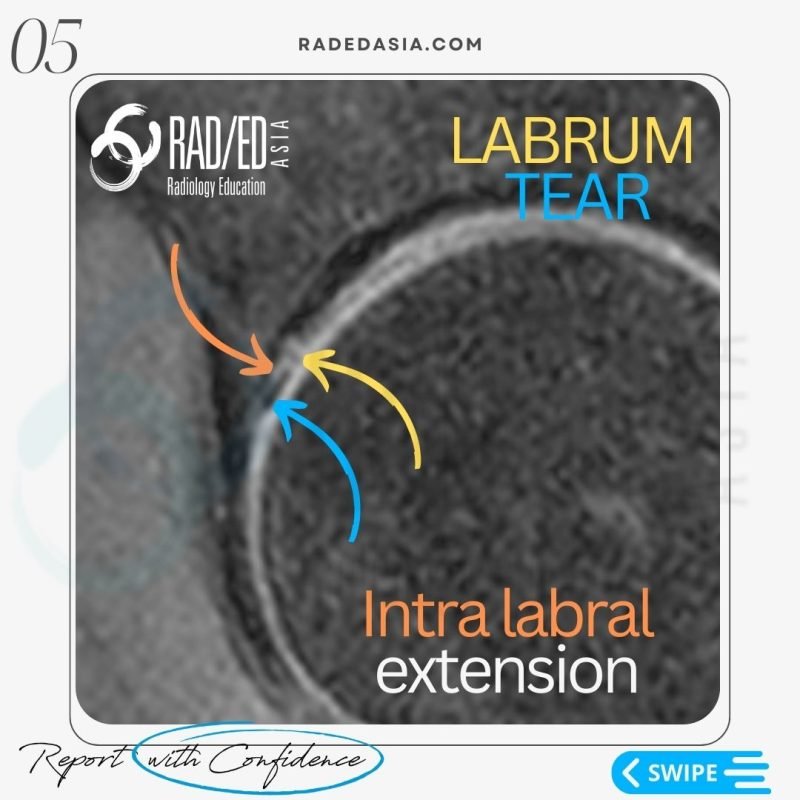 hip labrum labral tear mri radiology musculoskeletal radedasia