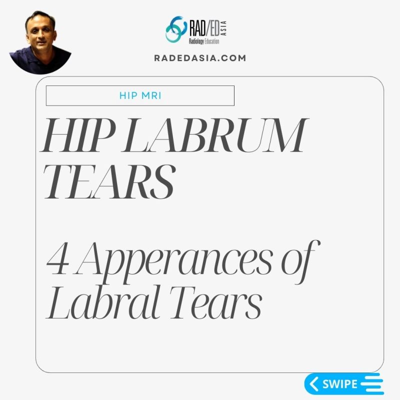 hip-labrum-labral-tear-paralabral-cyst-mri-radiology.jpg