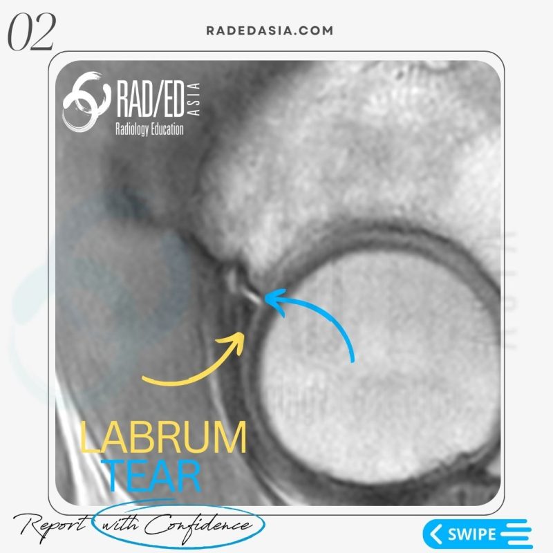 hip-labrum-labral-tear-radiology-mri-radedasia.jpg