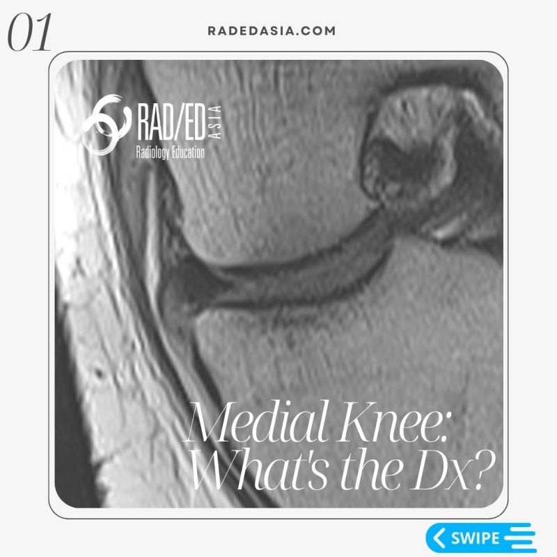 knee-mri-deep-mcl-meniscotibial-ligament-tear-dmcl-radiology.jpg