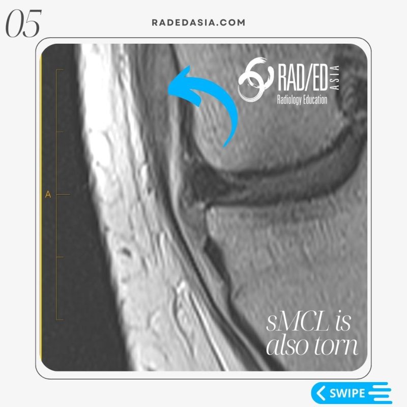 knee-mri-deep-mcl-meniscotibial-ligament-tear-smcl.jpg