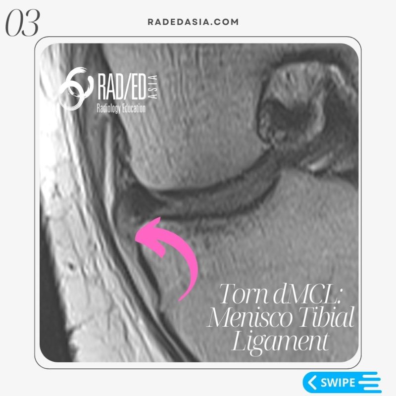 knee-mri-meniscotibial-ligament-tear-deep-mcl-radiology-dmcl.jpg