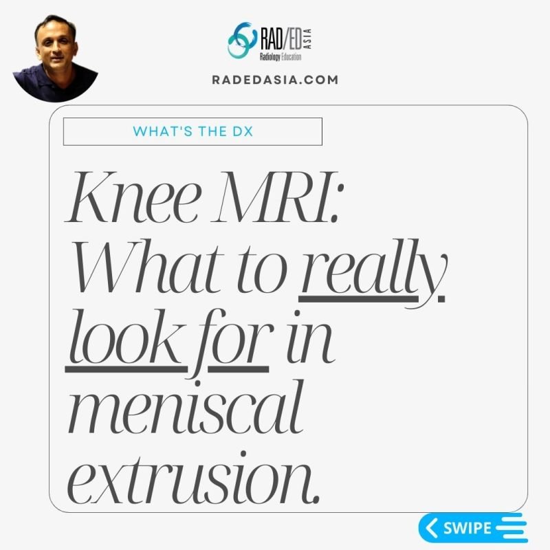 knee mri meniscus extrusion root tear radiology radedasia