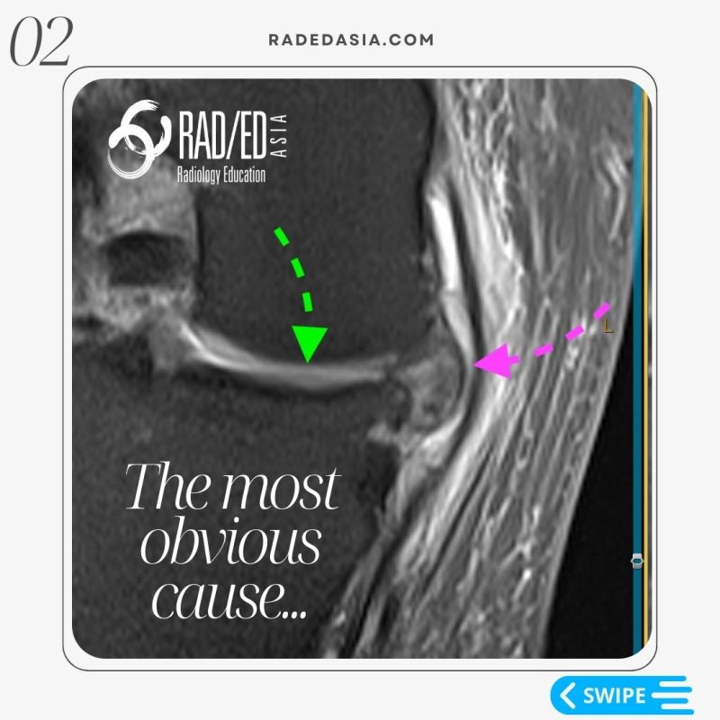 knee-mri-msk-meniscus-extrusion-root-tear.jpg