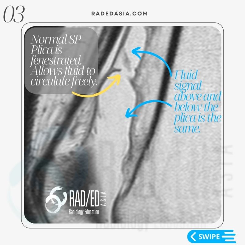 knee-mri-plica-suprapatellar-bursa-lipohemarthrosis.jpg