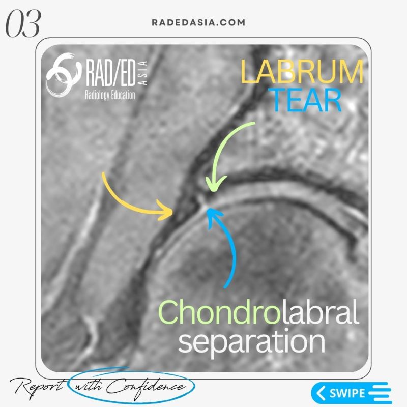 labrum-labral-tear-chondrolabral-separation-hip-mri-radiology-radedasia.jpg