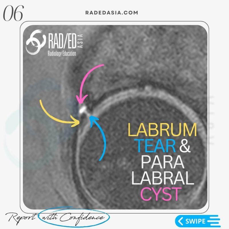 labrum-tear-intra-labral-hip-mri-radiology-radedasia.jpg