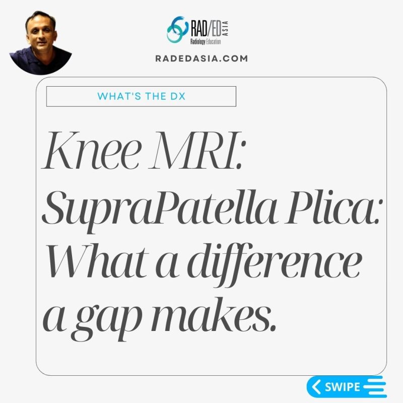 mri-knee-bursa-suprapatellar-plica.jpg