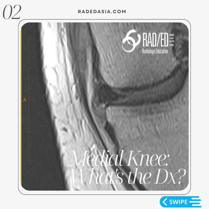 mri knee deep mcl meniscotibial ligament tear dmcl radiology