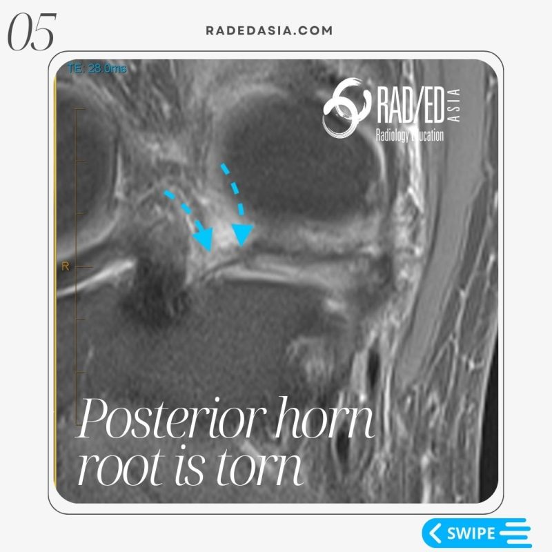 mri-knee-meniscus-extrusion-root-tear-radedasia-radiology.jpg