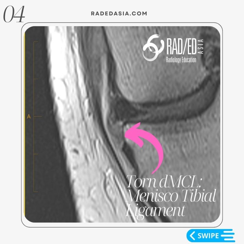 mri-knee-msk-musculoskeletal-deep-mcl-meniscotibial-ligament-tear-dmcl-radiology.jpg