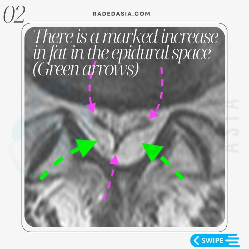 spine-epidural-lipomatosis-lumbar-thecal-sac-mri-radiology-radedasia.jpg