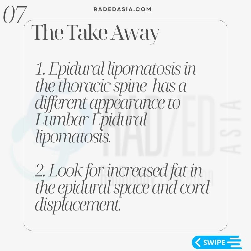 thoracic-epidural-lipomatosis-radiology-spine-spinal-mri.jpg