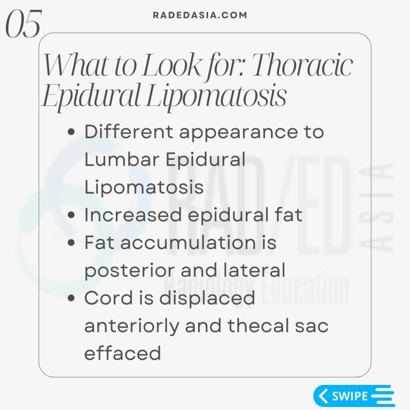 thoracic-epidural-lipomatosis-radiology-spine-spinal-mri-radedasia.jpg